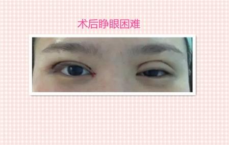 这些都是割双眼皮失败案例图片,看完你还敢割双眼皮吗?