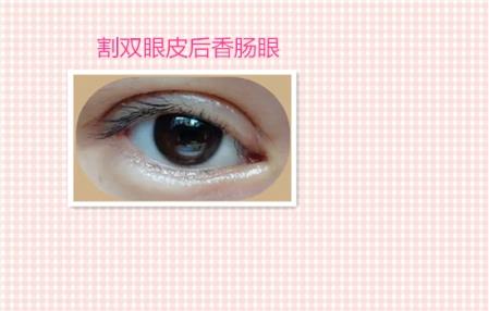 这些都是割双眼皮失败案例图片,看完你还敢割双眼皮吗?