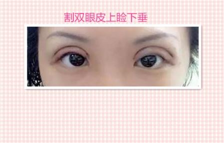 这些都是割双眼皮失败案例图片,看完你还敢割双眼皮吗?