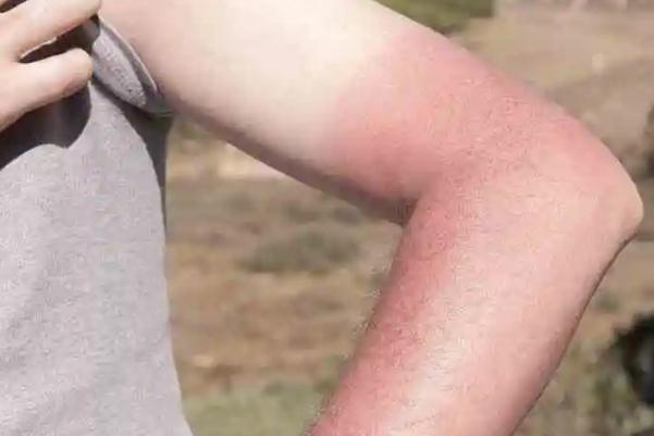 皮肤晒伤有灼烧感 皮肤晒伤有什么办法