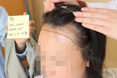 ​掉头发很厉害怎么办 掉头发和脱发有什么区别