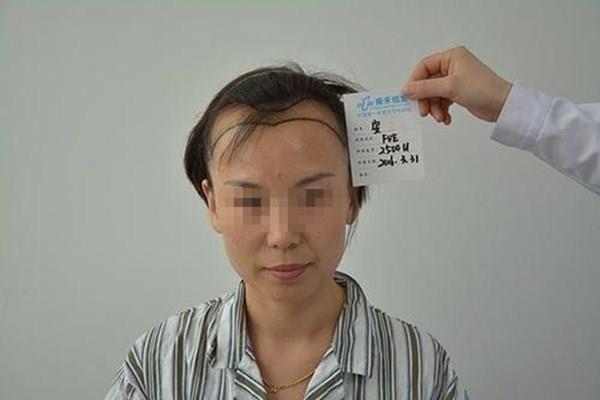 掉头发很厉害怎么办 掉头发和脱发有什么区别