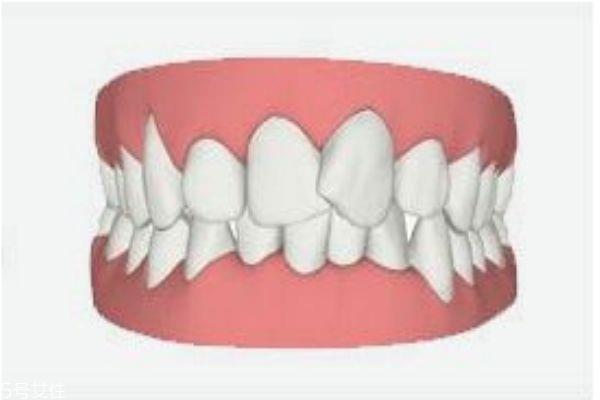 牙齿泛黄应该怎么办呢 为什么牙齿会泛黄 牙齿泛黄应该怎么办呢 为什么牙齿会泛黄